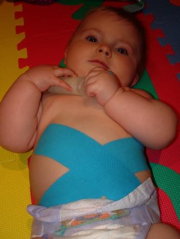 Kinesio Taping used to develop core abdominal strength to enable child to roll, sit upright, crawl, and complete gross and fine motor skills. 
